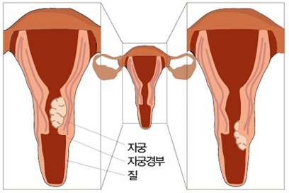 자궁경부암 검사